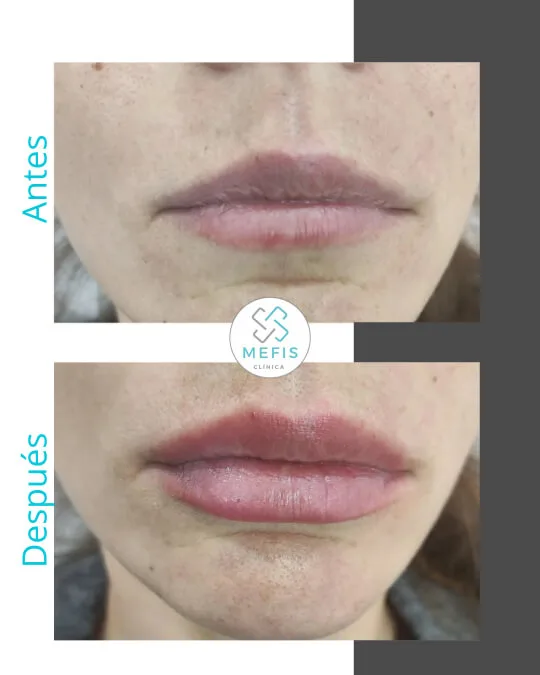 antes-despues-dermapen
